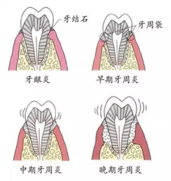 四个日常牙周护理让您彻底远离牙周病