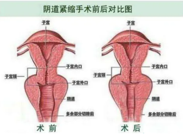 私密整形包括哪些部位