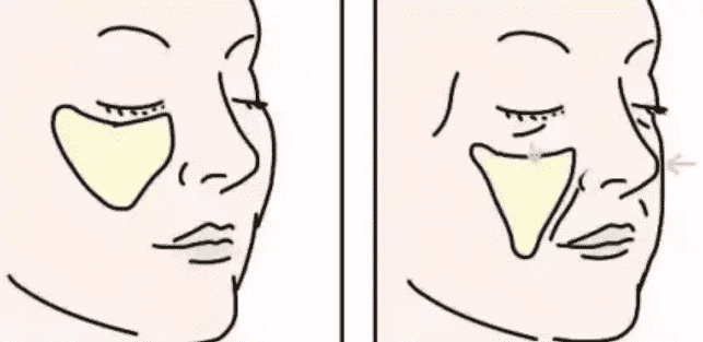 自体脂肪丰苹果肌效果如何快来看看吧
