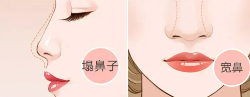 自体耳软骨隆鼻效果如何快来看看吧