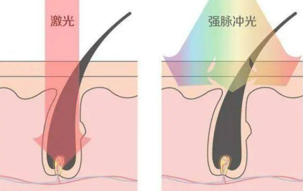 中南大学湘雅三医院怎么样内含激光嫩肤案例