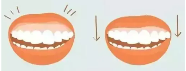 怎样能去露龈笑呢