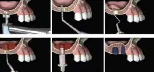 关于上颌窦内提升术您是否感到陌生呢