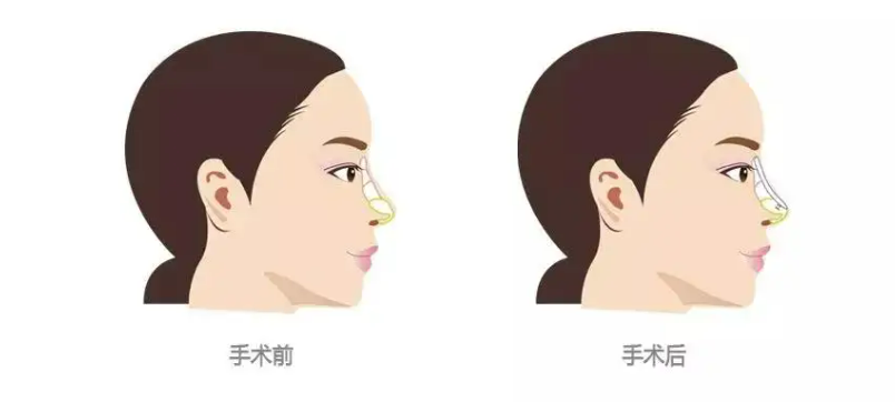 北京八大处整形医院隆鼻怎么样有哪些项目