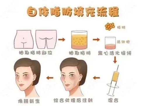 什么是脂肪填充