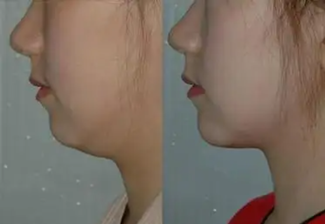 下巴吸脂术都是什么内容