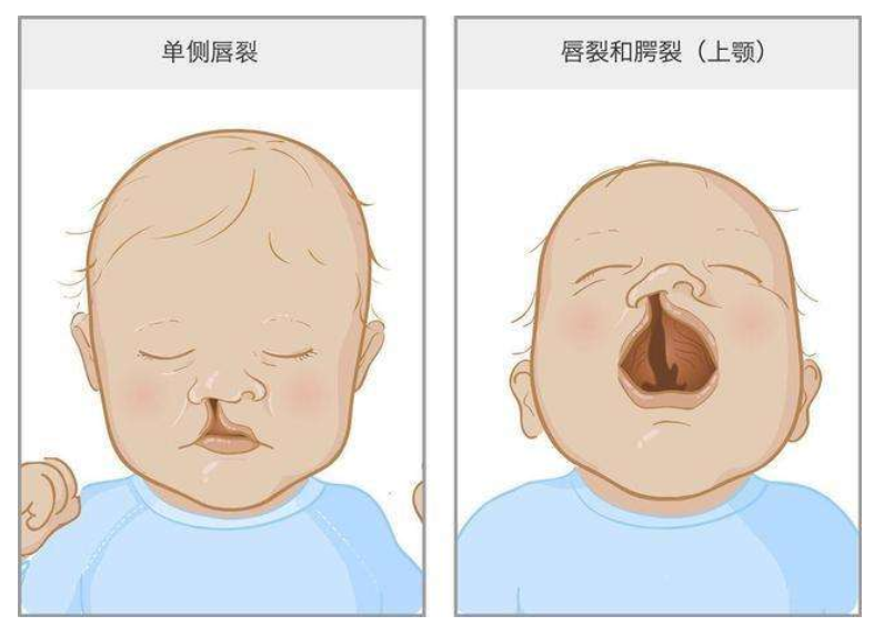 唇腭裂手术后恢复护理很重要