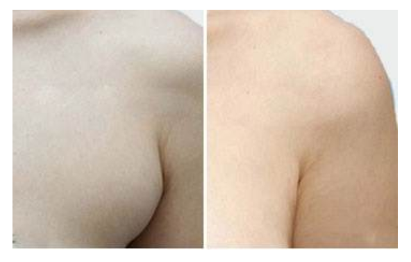 关于手术去副乳的方式你知道吗