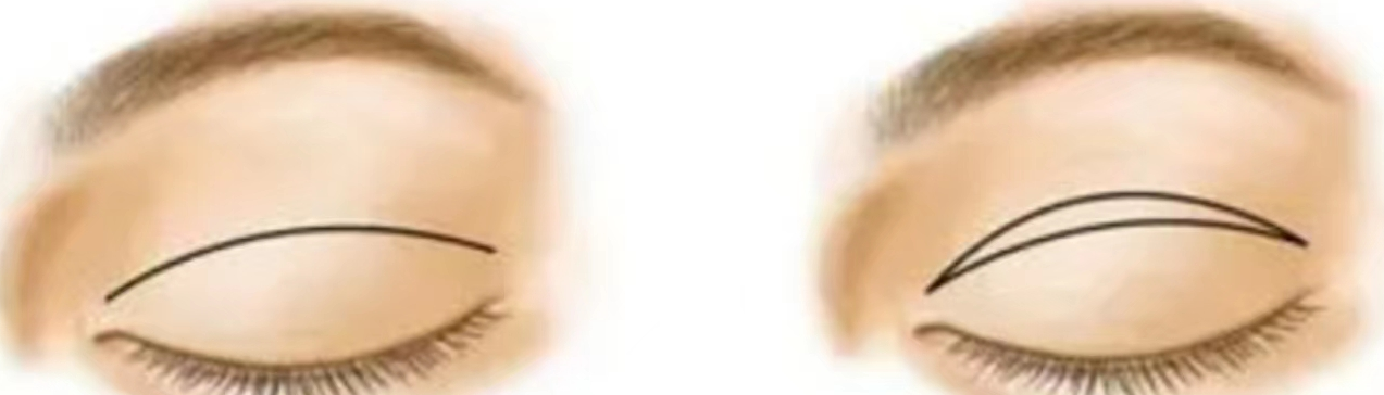 双眼皮手术失败的表现有哪些哪些因素会导致割双眼皮失败