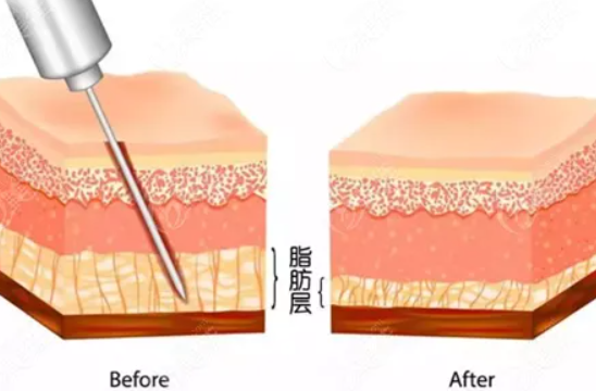 通过吸脂怎么达到减肥效果的