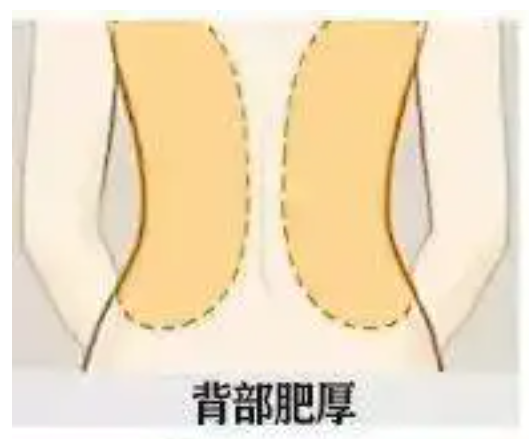 射频溶脂瘦背部能带来什么效果