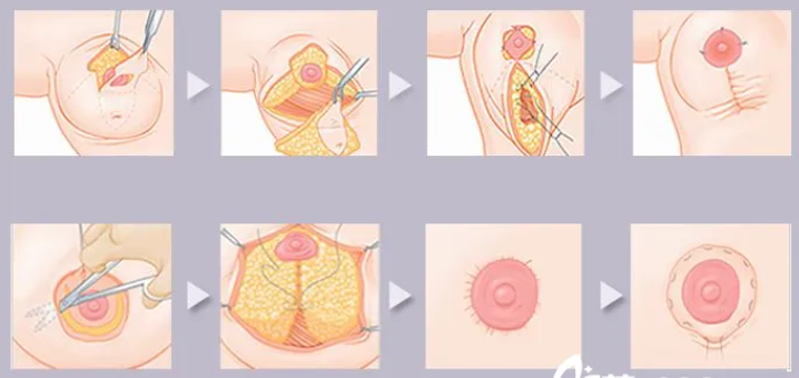 巨乳缩小术的作用是什么