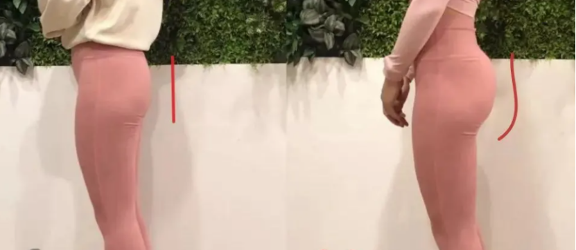 假体丰臀有哪些特征，需要注意什么