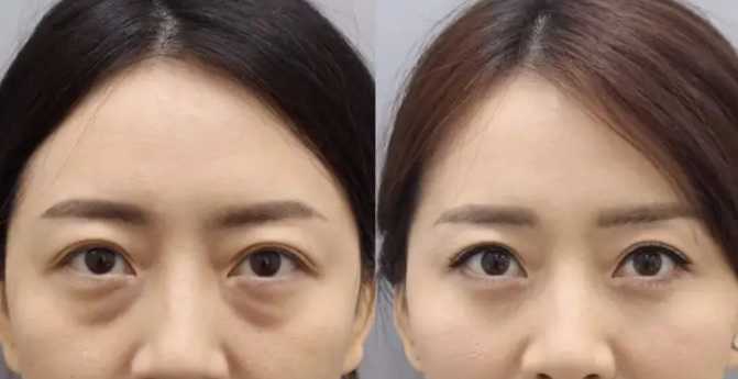 怎样袪眼袋