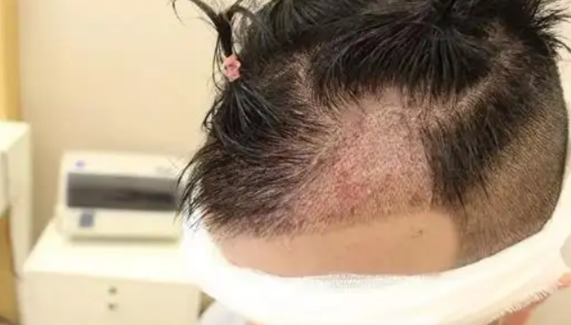 您对头发种植是否有了解呢