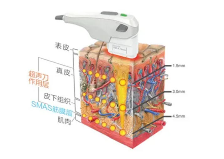 超声刀有什么原理和作用你知道吗