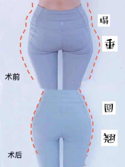 什么是埋线丰臀术后有什么主意事项