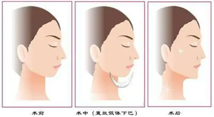 垫下巴有用吗垫下巴优缺点必看~