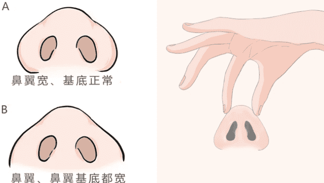 上海自体软骨隆鼻需要多少钱快来看看吧