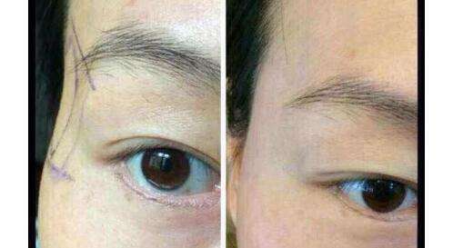 双眼皮手术后不想留疤怎样做