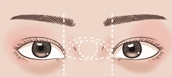 东方百合整形美容医院怎么样还有王世勇双眼皮案例一览~