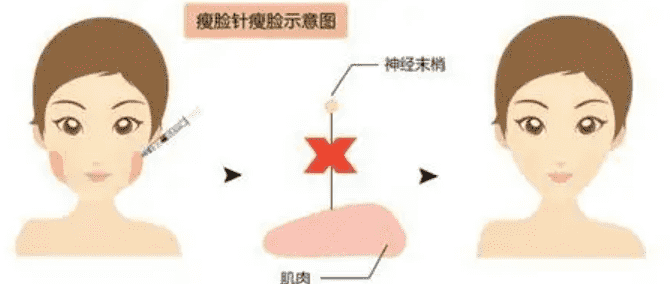 注射瘦脸针会反弹吗如何护理呢