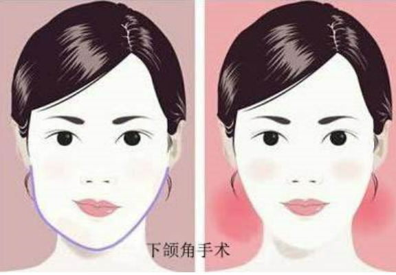 磨骨费用贵不贵磨骨会有后遗症吗想知道这些就进来看看吧