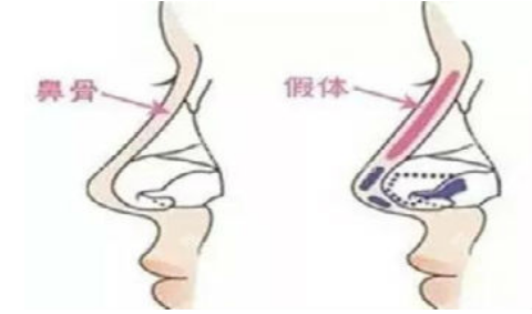 北京家恩德仁医院隆鼻怎么样隆鼻案例分享~