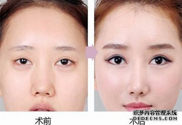 双眼皮手术修复术失败会怎么样？效果好吗？多少钱？