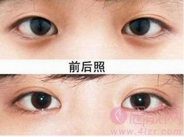 全切双眼皮有什么优点？需要多久恢复？