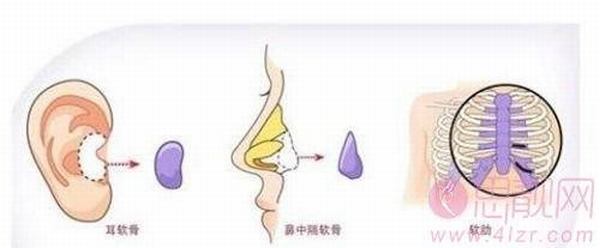 自体软骨隆鼻安全吗?多长时间可恢复?