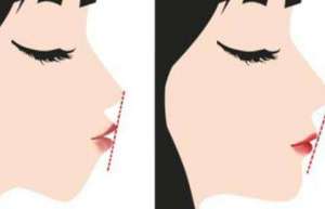 正颌和削骨有什么区别？流程是什么？